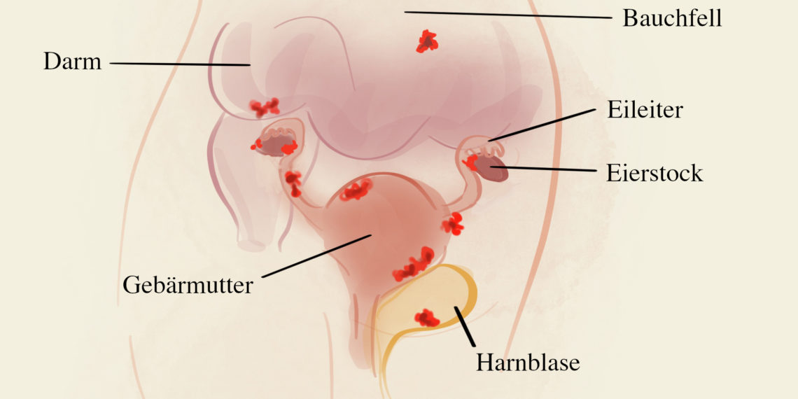 In der Regel schmerzhaft