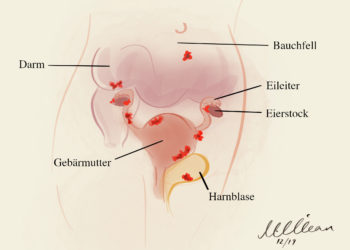 In der Regel schmerzhaft